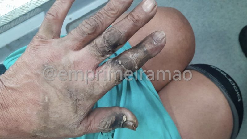 Idosa é agredida e queimada em Franca; companheiro foi preso
